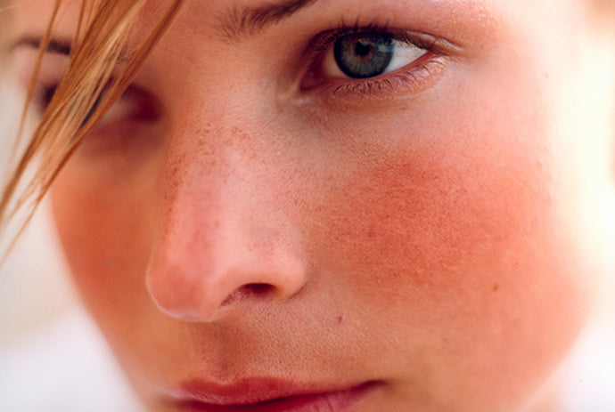 The Science Behind Rosacea: How To Rid The Red